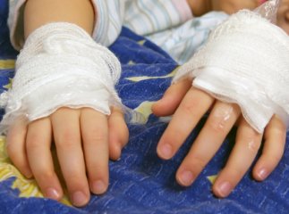 У селі на Мукачівщині під час пожежі дитина отримала опіки