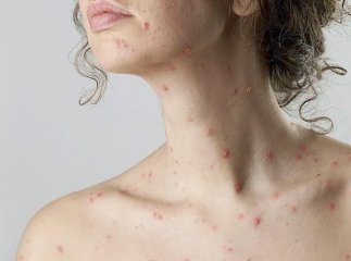 ВООЗ підтвердила вже майже 800 випадків віспи мавп у десятках країн світу: статистика