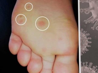 Науковці назвали новий симптом коронавірусу, який проявляється на тілі: фото