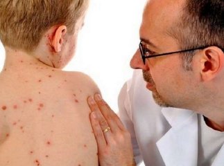 Помер від кору: вини лікаря у смерті 12-річного хлопчика немає