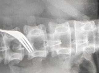 На Закарпатті чоловік проковтнув виделку. Його прооперували