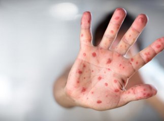 В області щодня реєструють нові випадки захворювання на кір