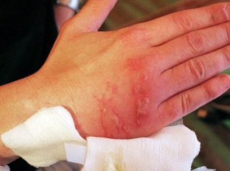 Жителька Верхьного Коропця під час коптіння м’яса серйозно обпекла руку