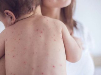 З початку року на кір захворіло майже 900 закарпатців