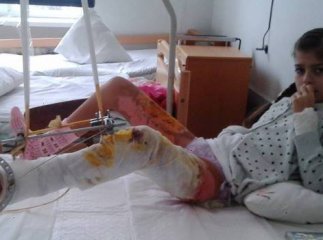 Винесено вирок суду у справі дівчинки, яка сильно постраждала і перенесла 28 операцій