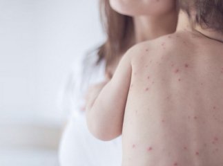 На Закарпатті готуються до можливого спалаху кору