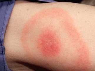 8 закарпатців захворіли на смертельно небезпечну хворобу