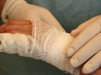 Мукачівка отримала опіки 30% тіла