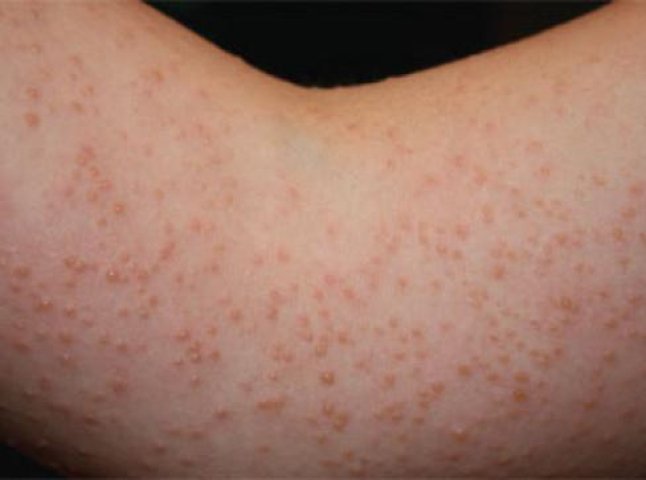 Шкіра вкривається пухирцями: частина закарпатців страждає від незвичної алергії