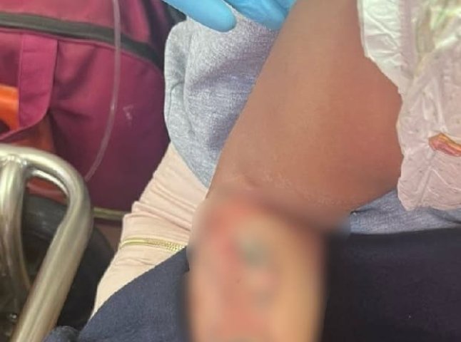 Швидку викликали лише через 5-6 годин: на Закарпатті дівчинка отримала опіки