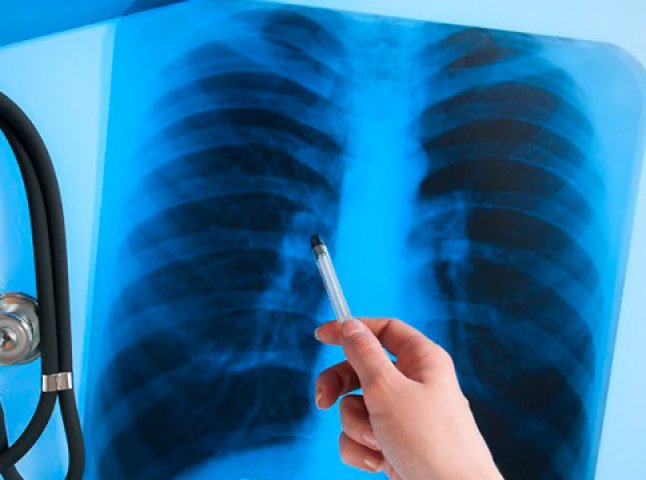 На Закарпатті зменшився рівень захворюваності на туберкульоз