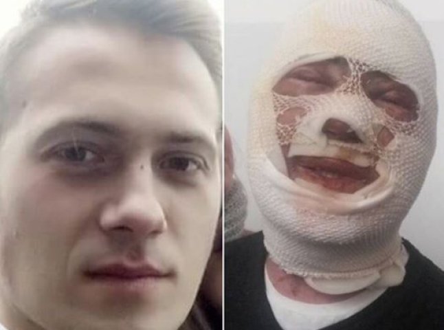 У соцмережі показали фото хлопця, якого в Ужгороді облили кислотою