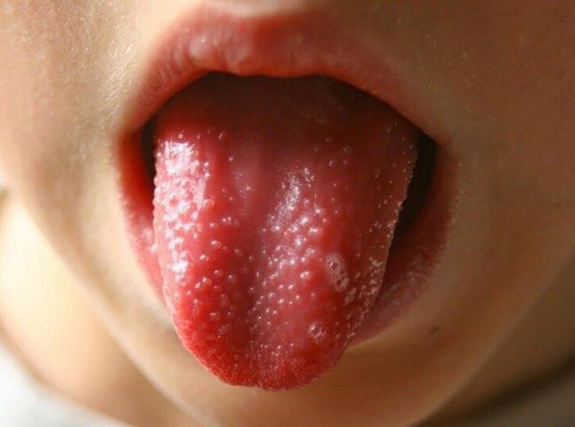 З’являються висип та ангіна: в Ужгороді серед дітей шириться інфекційне захворювання