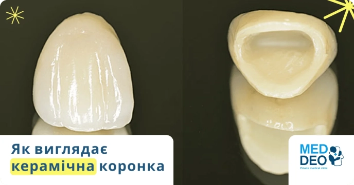 Вигляд керамічної коронки