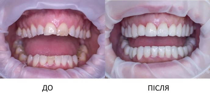 Керамічні коронки у клініці МЕД-ДЕО: які ціни у 2026 році та особливості протезування – 02