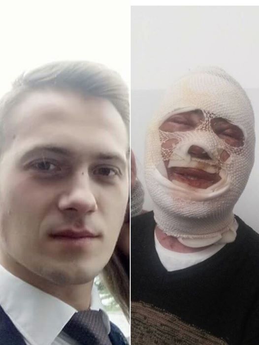 Чоловіка, що облив молодого ужгородця кислотою, судитимуть Чоловіка, що 25 січня 2018 року облив молодого ужгородця кислотою судитимуть