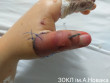 На Закарпатті 10-річний хлопчик відрубав собі палець. Лікарі провели важку операцію