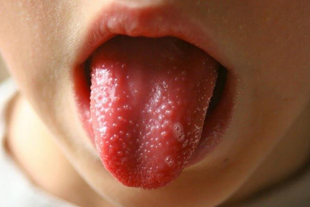 З’являються висип та ангіна: в Ужгороді серед дітей шириться інфекційне захворювання